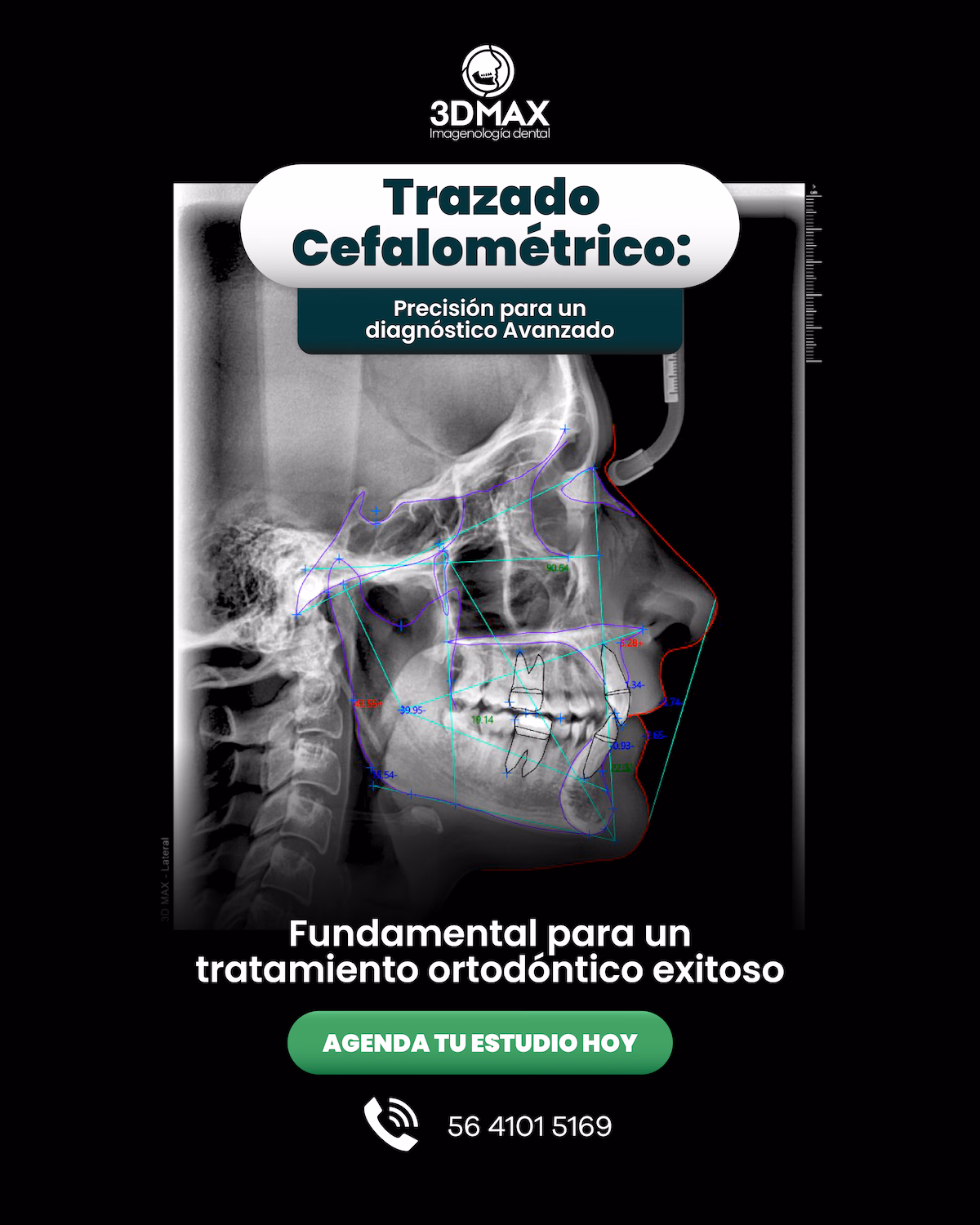 dmax Trazado